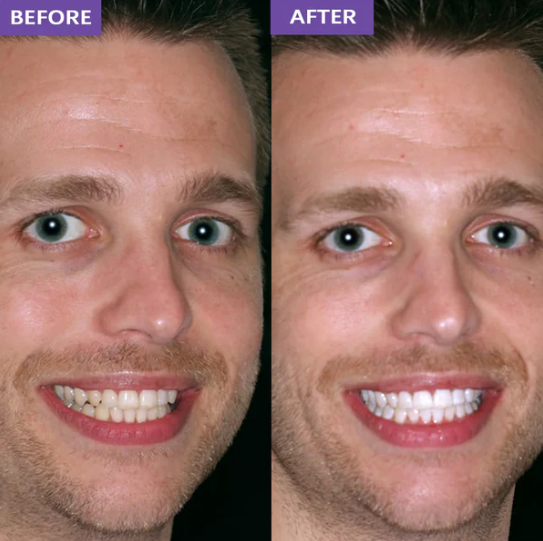 Claydon Co. Whitening Strips